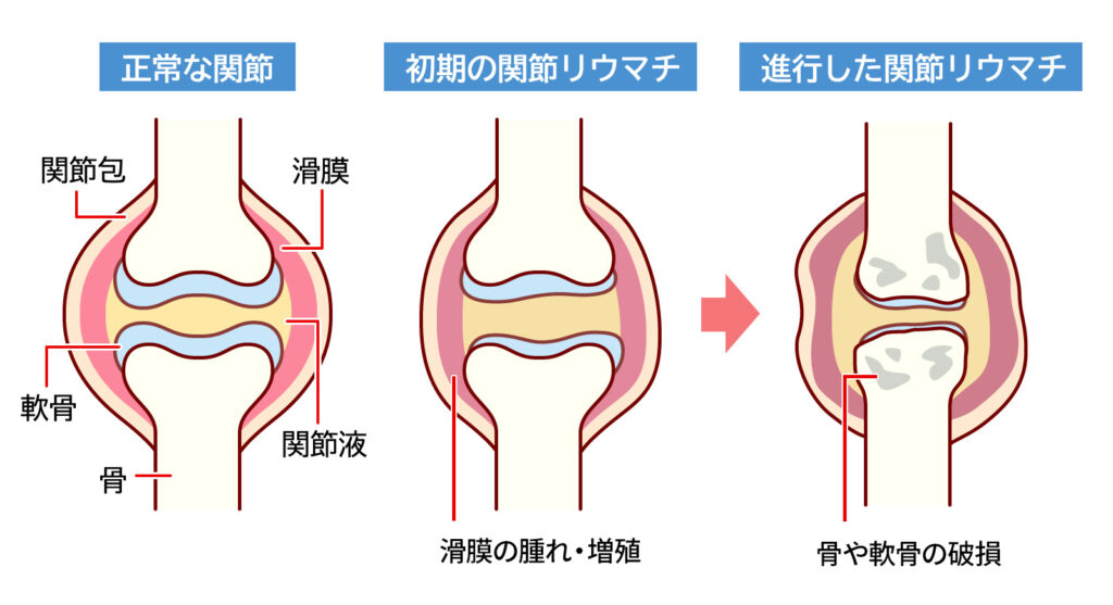 関節リウマチによる膝の痛みの仕組み