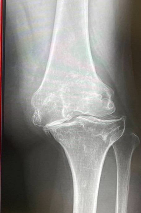 変形性膝関節による膝の痛みのある膝